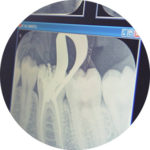 endodonzia conservativa